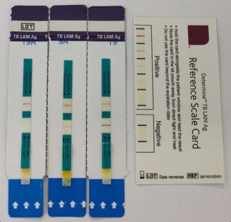 Determine TB LAM Test Strips From Three Patients In Thi Open I