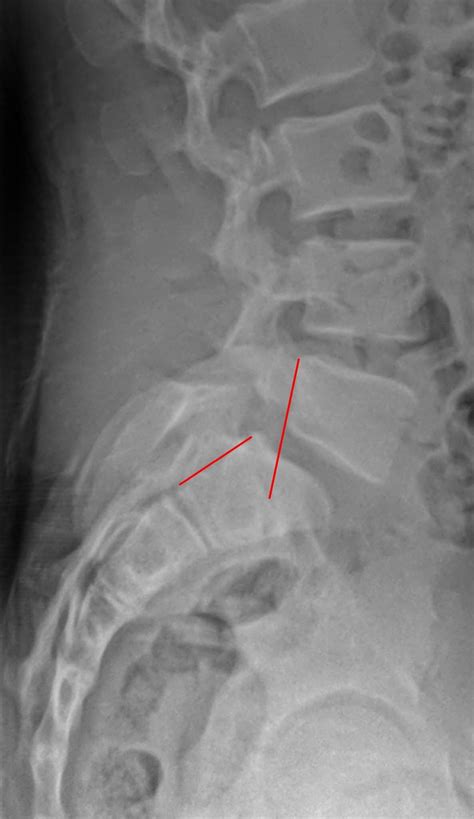 Spondylolisthesis — Prince Chiropractic Wellness Center