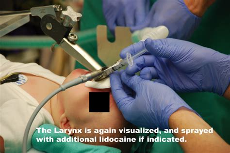 Direct Laryngoscopy And Fiberoptic Intubation At Quentin Davis Blog