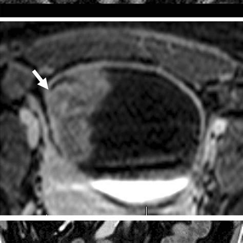 A Year Old Female With Urinary Bladder Leiomyosarcoma Axial T W A