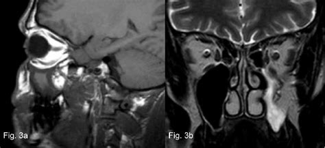 A Mr Imaging Shows Opacified Maxillary Sinus With Mixed Signal Download Scientific Diagram