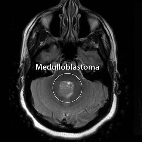 Neuroanatomy Glossary 4th Ventricle Tumors Draw It To Know It