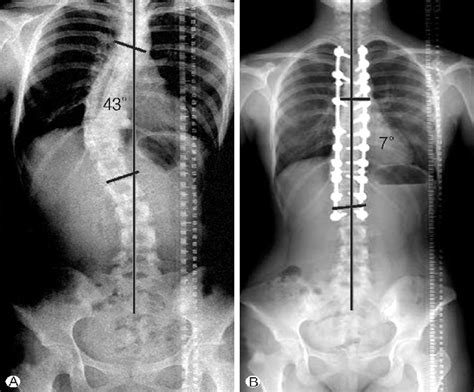 Eighteen Year Old Girl Patient With Lenke Type 1a Curve A Download Scientific Diagram