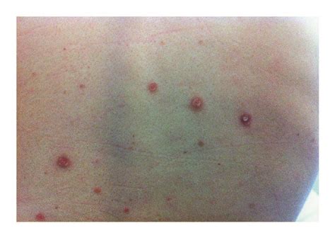 Generalized cutaneous erythematous maculae with distinct edges ...