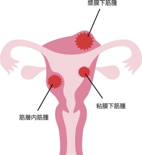 子宮筋腫 ｜レディースクリニックまぶち 岐阜市の産婦人科