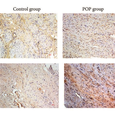 The expression of HIF 1α and BNIP3 are upregulated in USL tissues of