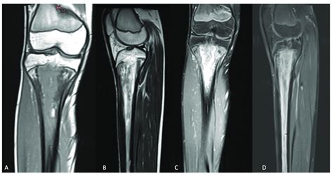 MRI Of The Right Knee Showing Primary Metaphyseal Acute Hematogenous