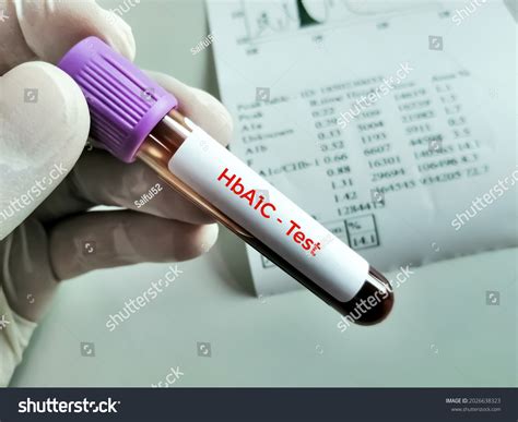 Blood Sample Hba1c Hemoglobin A1c Test Stock Photo 2026638323