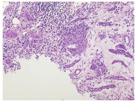 Idiopathic Granulomatous Interstitial Nephritis And Isolated Renal Sarcoidosis Two Diagnoses Of