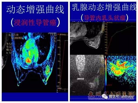 【医学影像科】成功开展乳腺磁共振功能成像及动态增强新技术