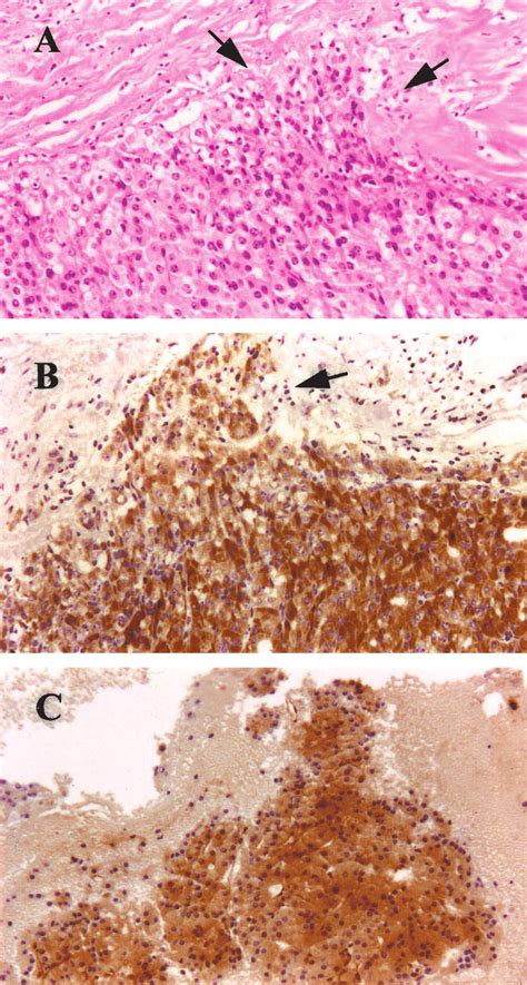 Galectin 3 Immunolocalization In A Positive Case Of Follicular Thyroid