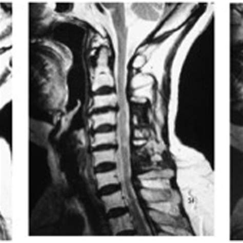 Sagittal Mri Demonstrating Pre Operative Multilevel Cervical Spinal Download Scientific Diagram