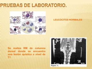 Caso Cl Nico De Cisticercosis Intramedular Ppt