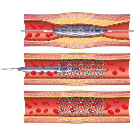 What Is A Stent And How Does It Treat Heart Disease