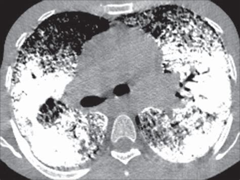 Scielo Brasil Can Chest High Resolution Computed Tomography