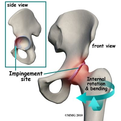 Femoro-acetabular Impingement (FAI) Syndrome