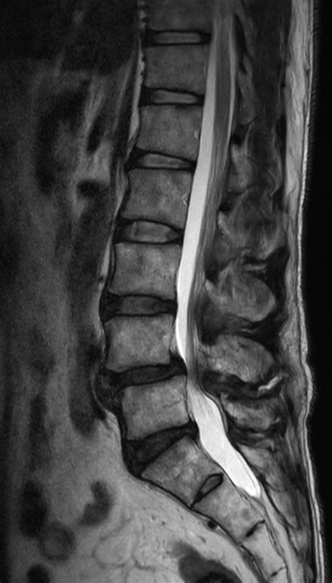 Lumbar Spine Disc Herniation Philips Mr Body Map