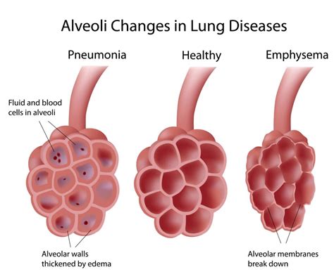 Emphysema Causes Complications Symptoms And Treatment