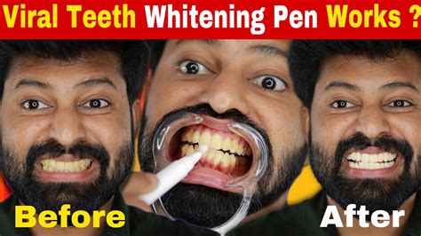 Teeth Whitening Pen Really Works Genuine Review Shadhik Azeez YouTube