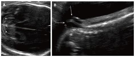 Arnold Chiari Malformation Ultrasound