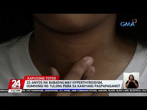 22 Anyos Na Babaeng May Hyperthyroidism Humihingi Ng Tulong Para Sa