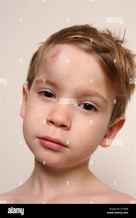 CHILD WITH HEMATOMA Stock Photo - Alamy