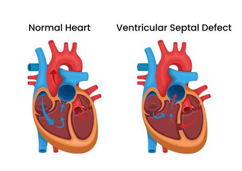 Ventricular Septal Defect