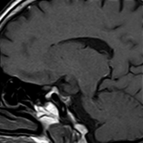 Radiopaedia Case Craniopharyngioma Nos Id Study Nc Commons