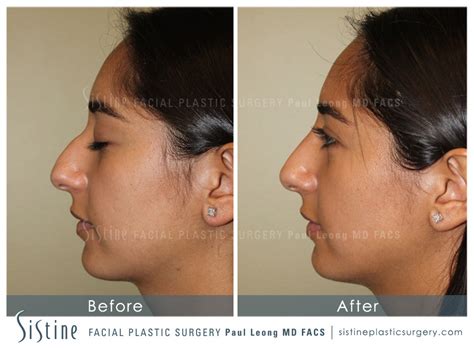 Restylane Juvederm Before And After 44 Sistine Facial Plastic Surgery