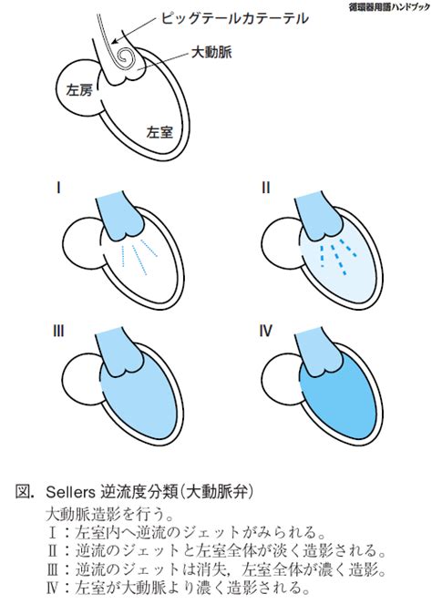 循環器用語ハンドブック（web版） 大動脈弁閉鎖不全 症 医療関係者向け情報 トーアエイヨー