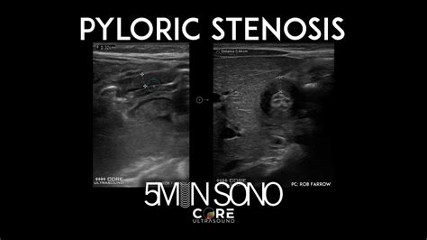 Minute Sono Pyloric Stenosis Youtube