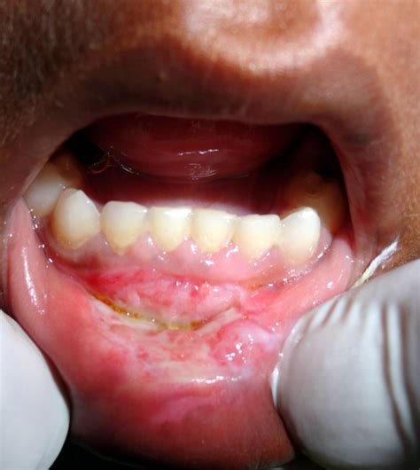 Management Of Chemical Burn In Oral Cavity Bmj Case Reports