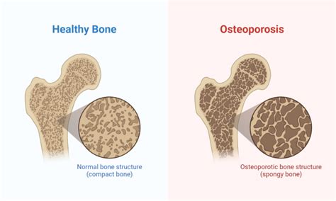 Osteomalacia Vs Osteoporosis Know The Difference My Endo Consult