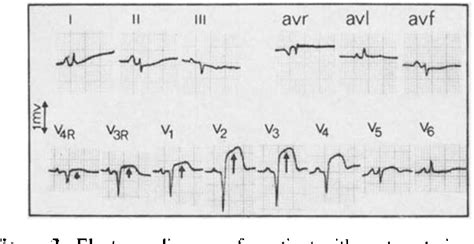 Figure From Electrocardiographic Findings In Acute Right Ventricular