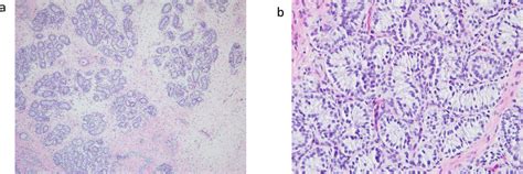 A XX Ovotesticular Disorder Of Sex Development Likely Caused By A SF NR A Variant PMC