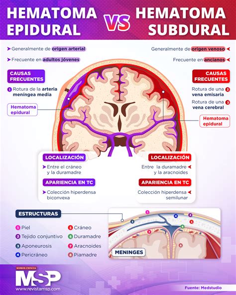 Hematoma Subdural E Epidural RETOEDU