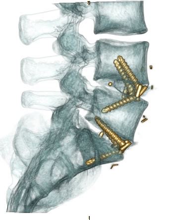 Advanced Spinal Instrumentation Images C N S Neurosurgery