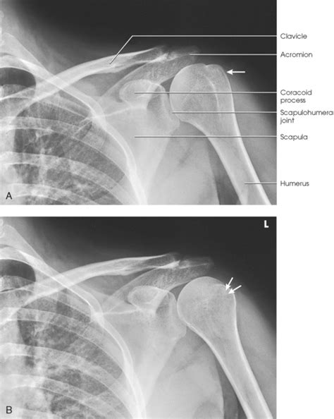 Shoulder Girdle Radiology Key