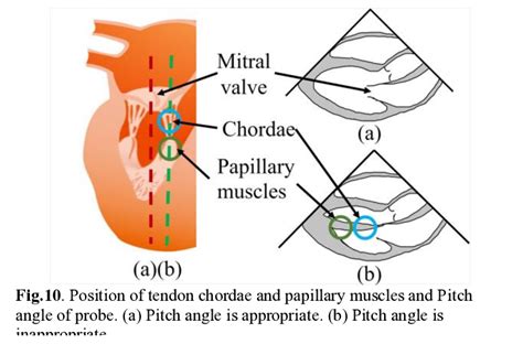 Parasternal Short Axis View At The Level Of The Mitral Valve B US