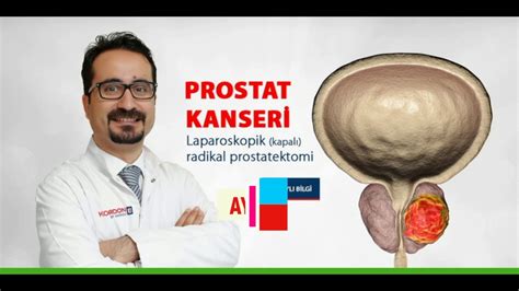 Prostat Kanseri Ameliyatı Prostata Işın Radyoterapi Tedavisi Doç