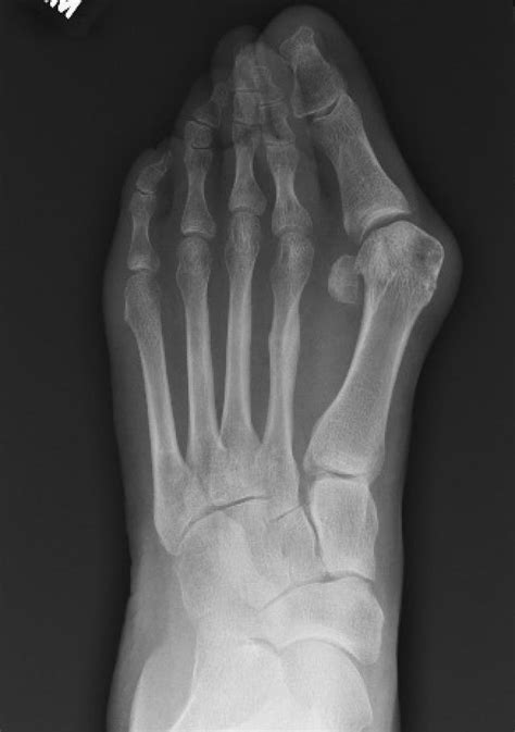 Hallux Valgus Foot Ankle Orthobullets