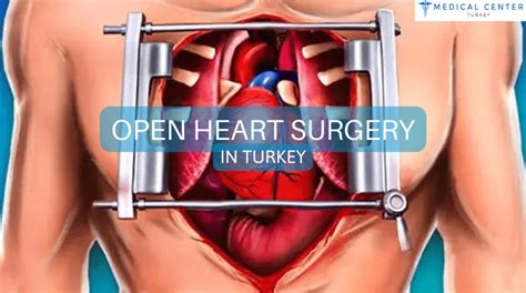 Open Heart Surgery In Turkey Mct