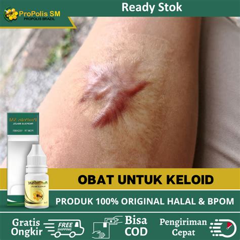 Jual Obat Keloid Daging Tumbuh Obat Keloid Obat Untuk Keloid Obat