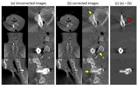 Metal Artifact Reduction In X Ray Ct Via Ray Profile Correction