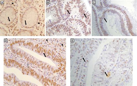 PELP1 MNAR Expression In Normal Mucosa A Adenomas B C And