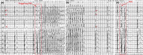 Electrocardiograms Showing Early Repolarization And Ventricular