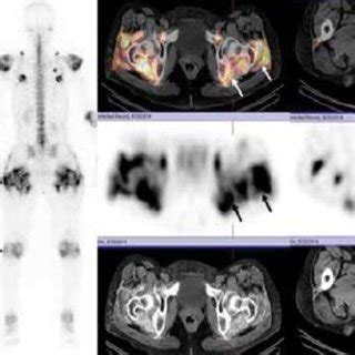 A D Anterior A And Posterior B Full Body Scans Show Heterogeneous