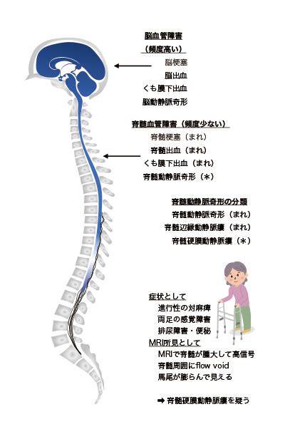 「脊髄梗塞」に対する理解を深めるために―佐藤弘道の病気について考える― ワールドニュースラボ