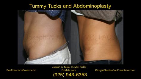 Tummy Tuck Abdominoplasty In The San Francisco Bay Area Youtube