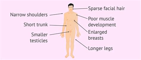 Klinefelter S Syndrome Causes Symptoms Diagnosis Off